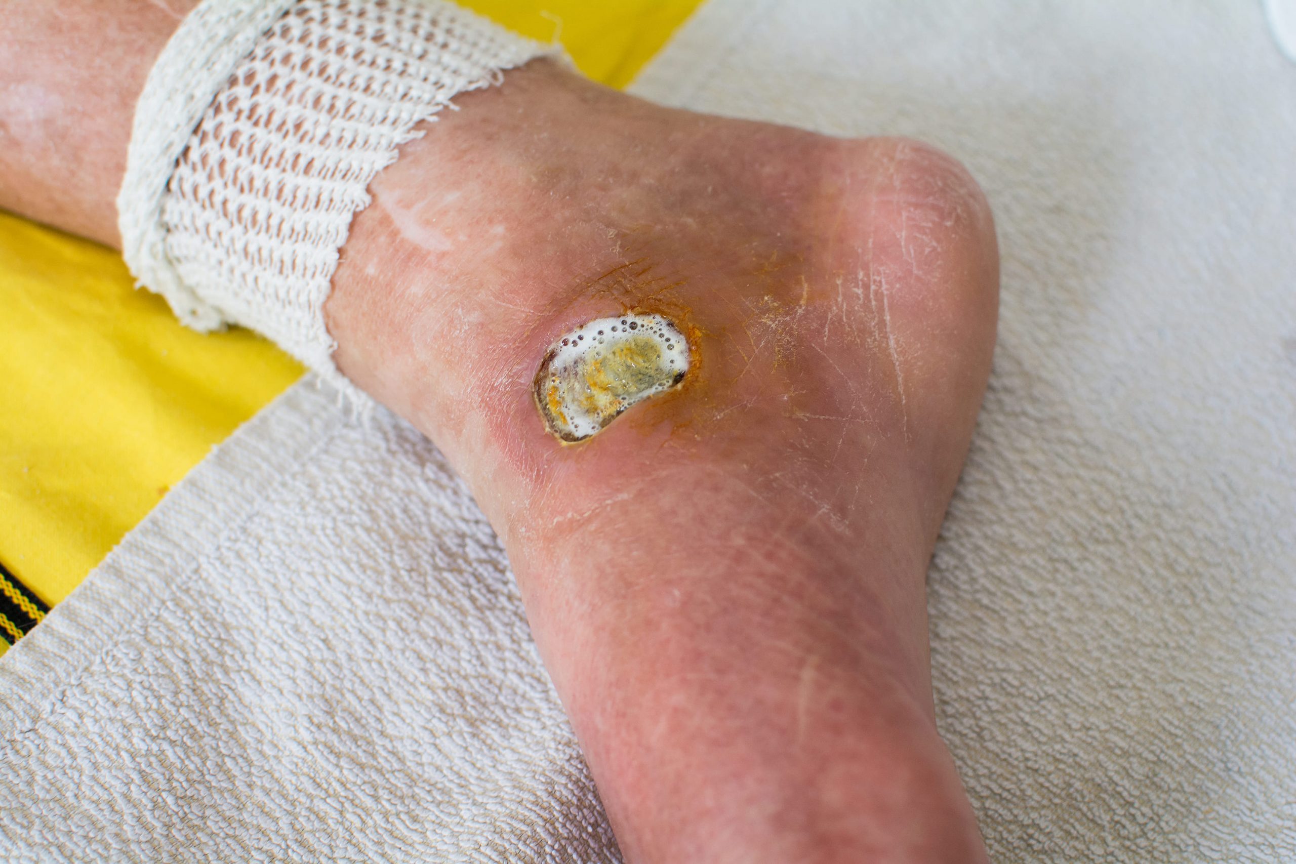 Diabetic Foot Ulcer